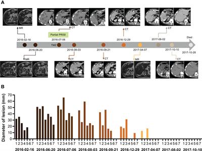 125I Radiotherapy combined with metronomic chemotherapy may boost the abscopal effect, leading to complete regression of liver metastasis in an SCLC patient with a 58.5-month OS: a case report